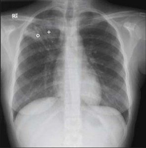 Rontgen dada menunjukkan tuberkulosis pulmoner